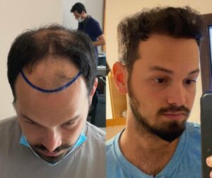 לפני ואחרי שינוי של מטופל השתלת שיער, הדגשת הצפיפות המשוקמת וקו השיער בעל המראה הטבעי.