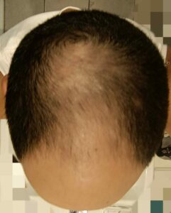 תקריב של קרקפת גבר חושף שיער דליל משמעותי בחלק האמצעי של ראשו