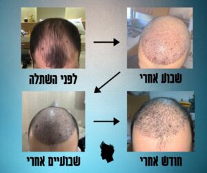 קרקפת של מטופל מציגה את ציר זמן ההתקדמות לאחר הליך שיקום שיער.