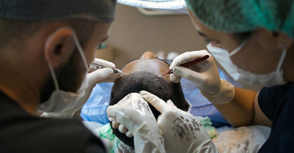 תמונה של מנתחים המבצעים ניתוח השתלת שיער בקפדנות לתוצאות מיטביות.