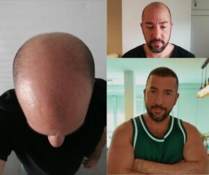 תוצאה של השתלת שיער של גבר לאחר שלוש השתלות