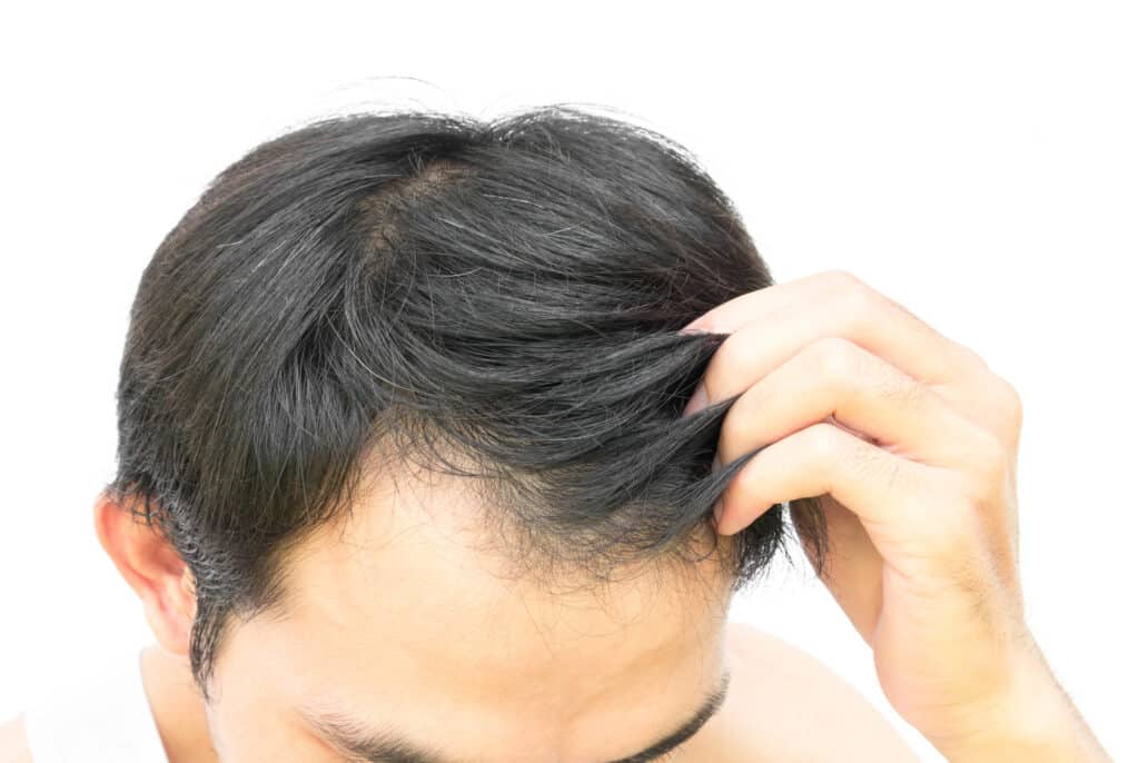 השתלת שיער FUE מתאימה לגברים ונשים כאחד המחפשים פתרון קבוע לנשירת שיער