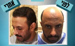 לפני ואחרי השוואה של גבר מקריח שהפך לאדם בטוח עם ראש מלא לאחר השתלת שיער.