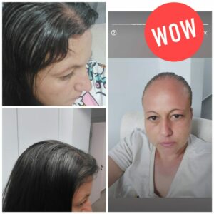 הליך השתלת שיער של אישה לפני ואחרי.