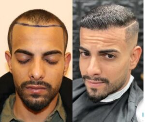 תמונת לפני ואחרי המדגישה את השינוי שהושג באמצעות השתלת שיער DHI.