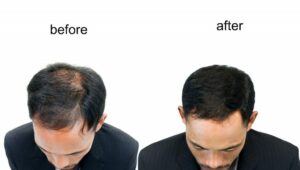 שינוי מדהים של כתר מקריח לקו שיער עבה וטבעי למראה לאחר הליך השתלת שיער.
