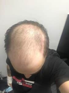 דילול שיער ניכר של גבר לפני השתלת שיער