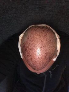 אדם מראה את הקרקפת שלו לאחר ניתוח השתלת שיער.